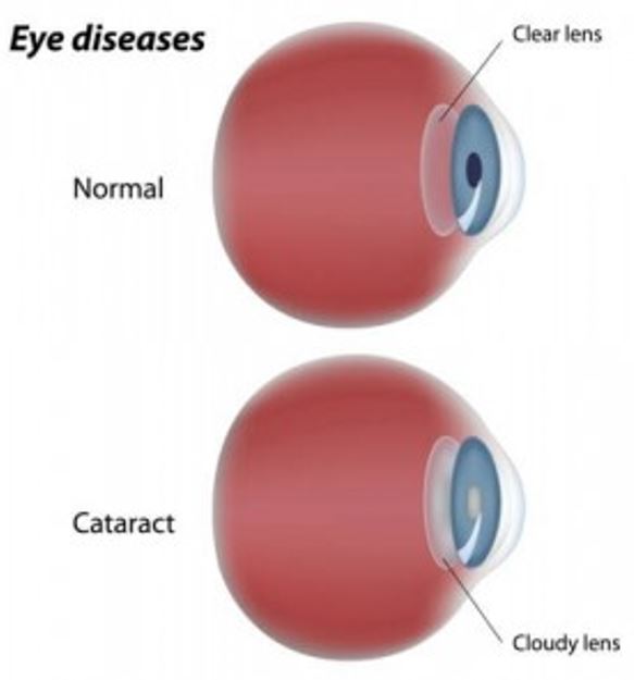 cataracts eye disease