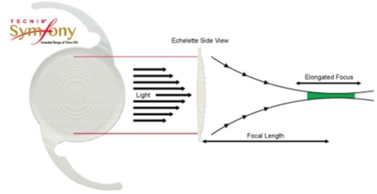 tecnis symfony lens